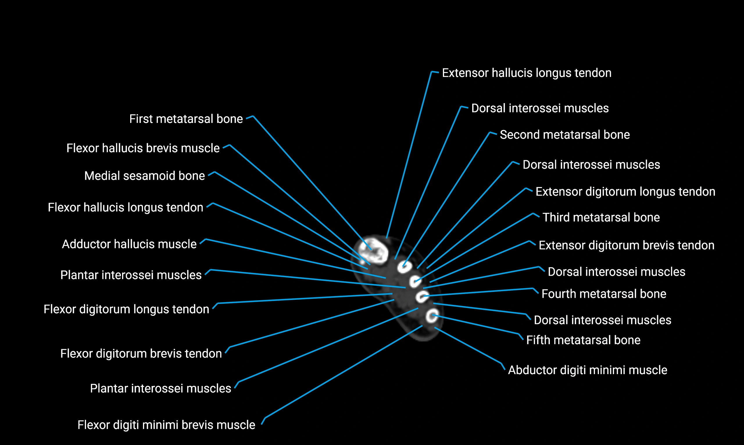 CT lower limb axial cross sectional anatomy labelled image 190 (2).webp